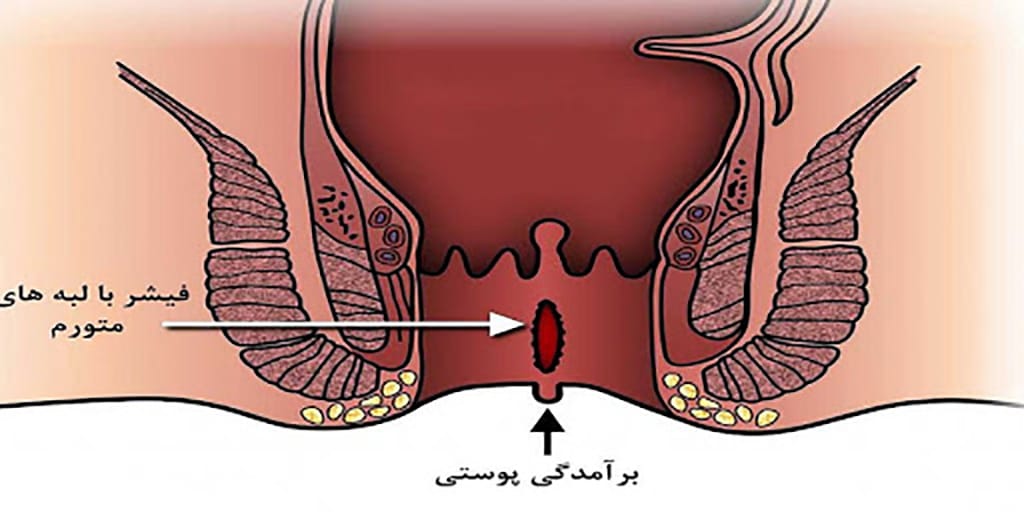 شقاق مقعد چیست