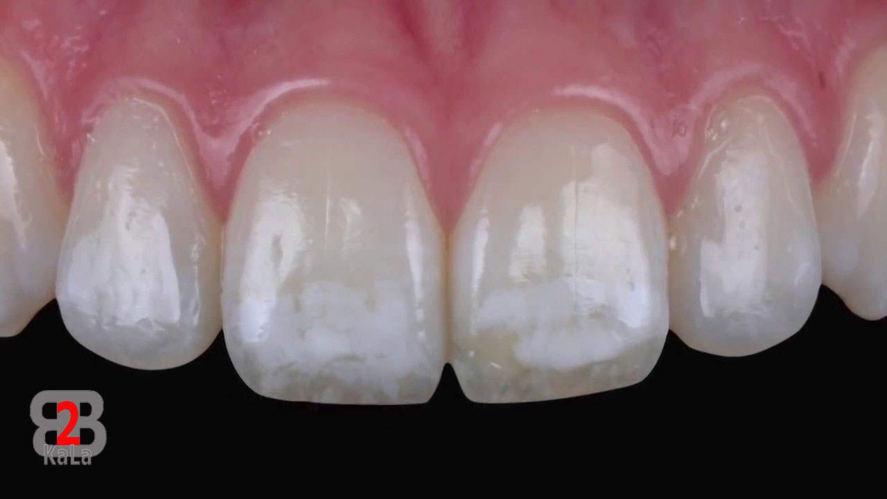 دلایل ایجاد لکه های سفید روی دندان و راه های درمان آن