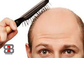 ریزش مو در مردان 