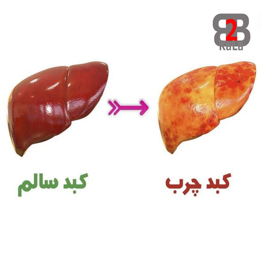 همه چیز درباره کبد چرب